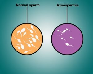 Azospermi