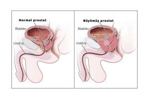 İyi huylu prostat