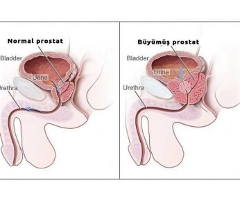İyi huylu prostat
