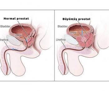 iyi-huylu-prostat İyi huylu prostat