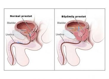 İyi huylu prostat