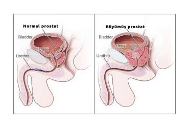 İyi huylu prostat