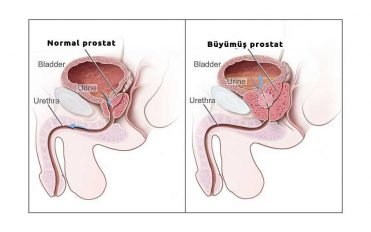 İyi huylu prostat
