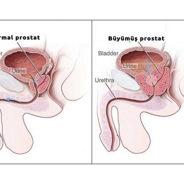 iyi-huylu-prostat İyi huylu prostat
