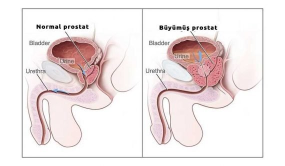 İyi huylu prostat