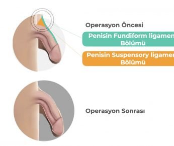 Penis büyütme ameliyatı