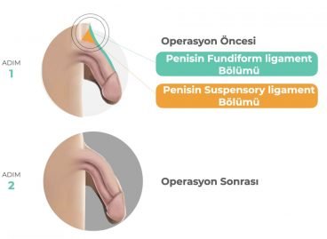 Penis büyütme ameliyatı