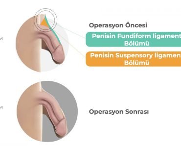 Penis büyütme ameliyatı
