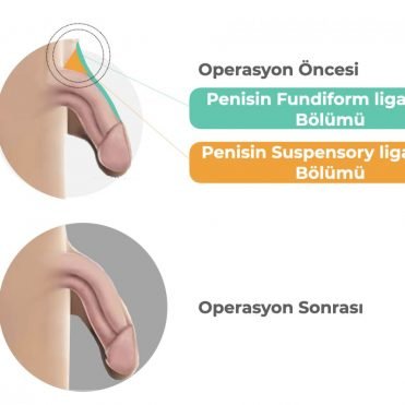 Penis büyütme ameliyatı Penis büyütme ameliyatı